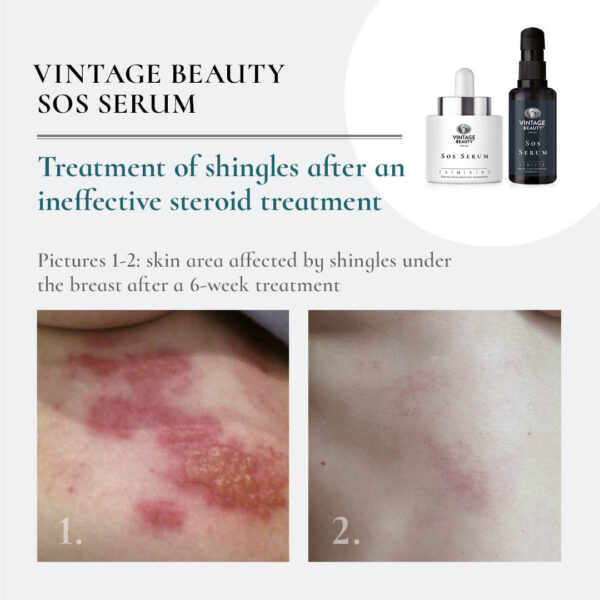 SOS serum
