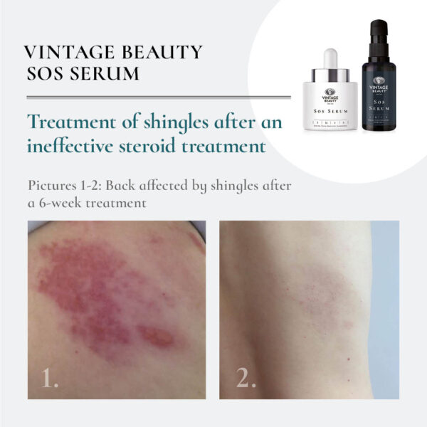 SOS serum