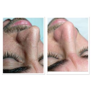 enzymatic peeling treatment before-after photos by Gabriella Rey-Fogarasy (beautician)