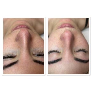 enzymatic peeling treatment before-after photos by Gabriella Rety-Fogarasy (beautician)