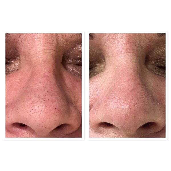 enzymatic peeling treatment before-after photo by Eva Kondas (beautician)